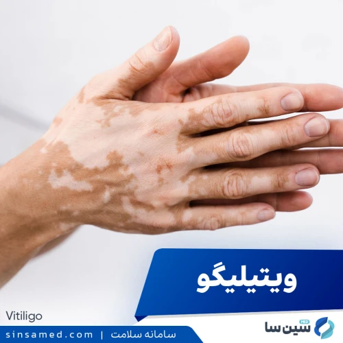 بیماری ویتیلیگو (پیسی) | علل بروز، نشانه ها، تشخیص و درمان