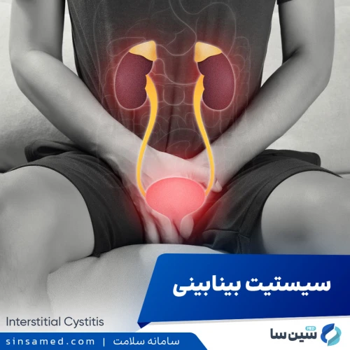 بیماری سیستیت بینابینی | علل بروز، نشانه ها، تشخیص و درمان