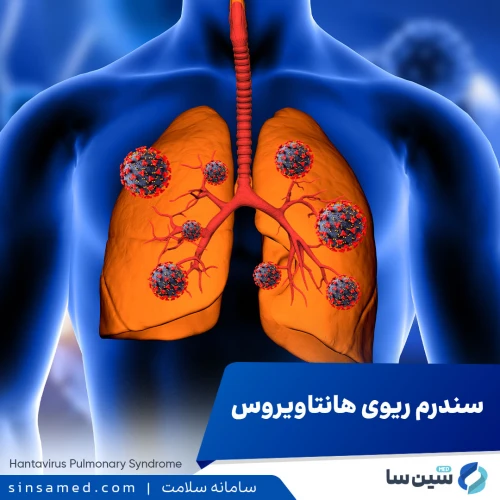 سندرم ریوی هانتاویروس | علل بروز، نشانه ها، تشخیص و درمان