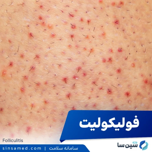 التهاب فولیکول (فولیکولیت) | علل بروز، روش تشخیص و درمان