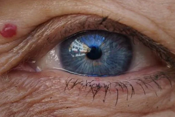 ایمپلنت شبکیه، امید تازه برای بازیابی بینایی مرکزی در AMD پیشرفته