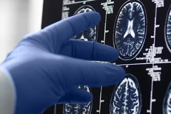 تغییرات جریان خون و متابولیسم می‌تواند آلزایمر را زودتر آشکار کند