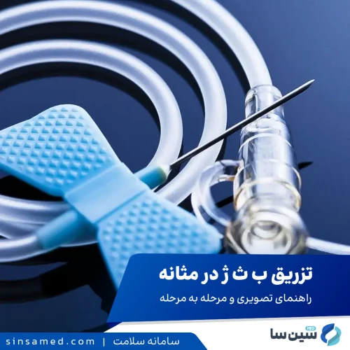 تزریق ب ث ژ در مثانه: راهنمای تصویری و مرحله به مرحله
