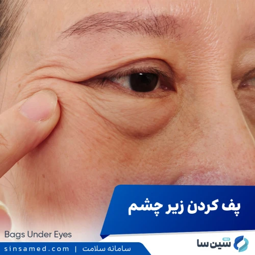 پف کردن زیر چشم | علل بروز، نشانه ها، تشخیص و درمان