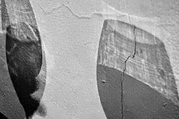 مصرف زیاد الکل ریسک سرطان کولورکتال را تا ۹۱٪ افزایش می‌دهد