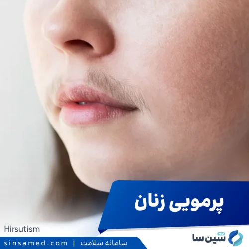 پرمویی زنان (هیرسوتیسم) | علل بروز، نشانه ها، تشخیص و درمان