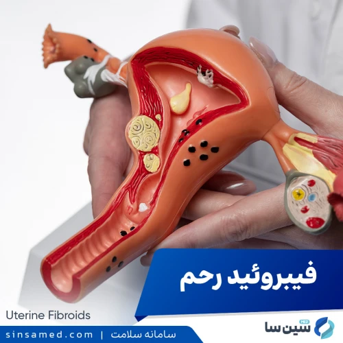 فیبروئید رحم | علل بروز، نشانه ها، روش تشخیص و درمان