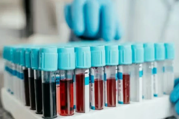 آزمایش خون p-tau217 خطر آلزایمر را ۱۰ سال زودتر پیش‌بینی می‌کند