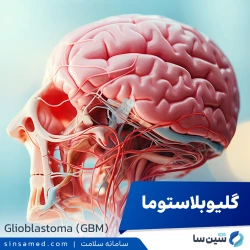 تومور مغزی گلیوبلاستوما | علل بروز، نشانه ها، تشخیص و درمان