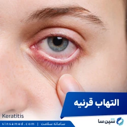 التهاب قرنیه (کراتیت)