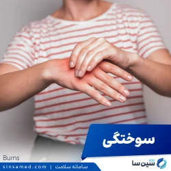سوختگی