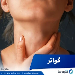 گواتر