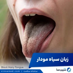 زبان مودار  سیاه