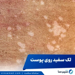 علت لکه‌های سفید روی صورتم چیست و چگونه می‌توانم آنها را درمان کنم؟