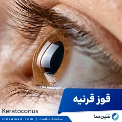 قوز قرنیه (کراتوکونوس)