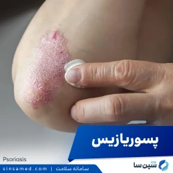 پسوریازیس | علل بروز، نشانه ها، روش تشخیص و درمان