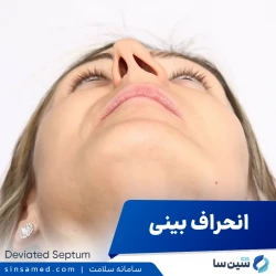 انحراف بینی