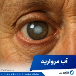 آب مروارید