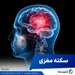 سکته مغزی