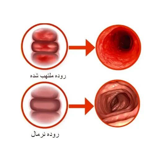 اختلالات روده ای از موارد احتیاطی مصرف داروی آکاربوز