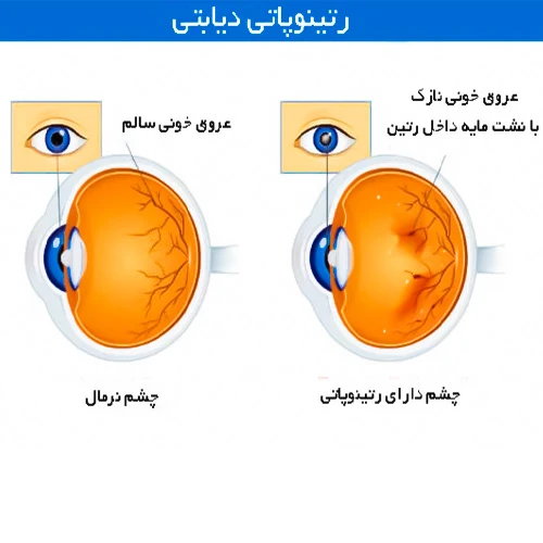 داروی آفلیبرسپت چشمی (آیلیا) مناسب درمان رتینوپاتی دیابتی