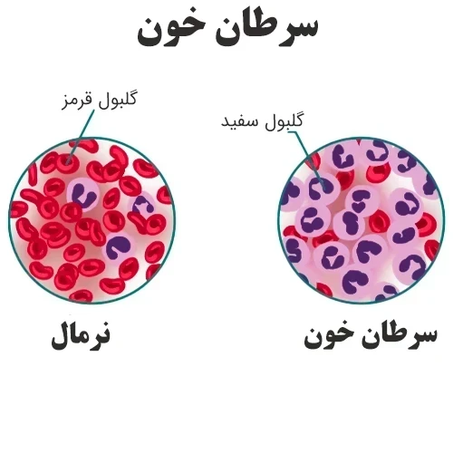 درمان نوعی سرطان خون با داروی آلمتوزوماب