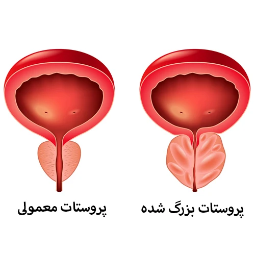 درمان علائم هایپرپلازی خوش خیم پروستات با داروی آلفوزوسین