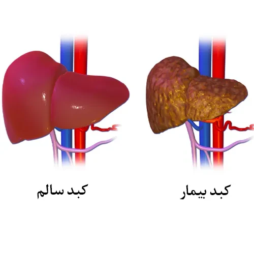 بیماری های کبدی از موارد احتیاطی مصرف داروی کوآموکسی کلاو