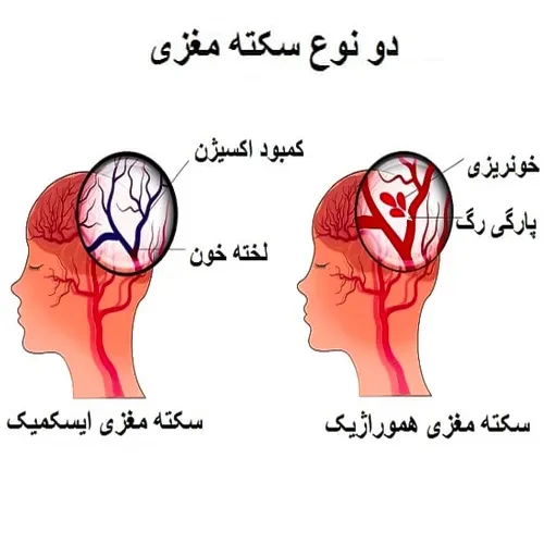 جلوگیری از ایجاد لخته خون با داروی آپیکسابان