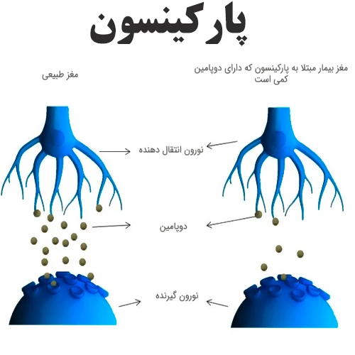 درمان بیماری پارکینسون با داروی آپومورفین