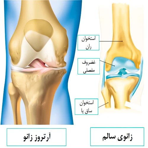 تاثیر داروی آپرمیلاست بر آرتروز 