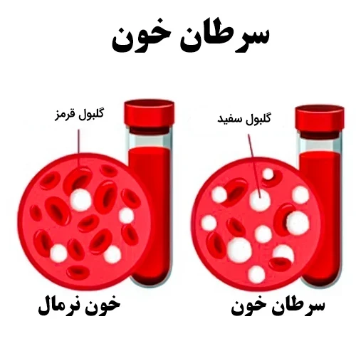 تاثیر آرسنیک تری اکسید در درمان سرطان خون