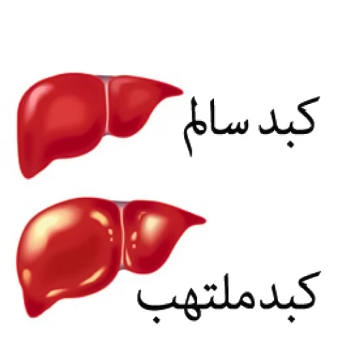 بیماری های کبدی از موارد احتیاطی مصرف داروی یسکارتا 