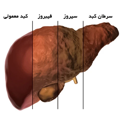 بیماری کبدی از موارد احتیاطی مصرف داروی آزاتیوپرین