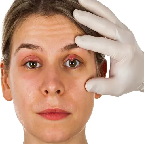 درمان عفونت های چشمی با پماد چشمی باسیتراسین و پلی میکسین