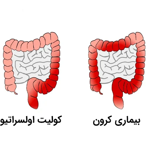 درمان بیماری کولیت اولسراتیو با مصرف داروی بالسالازید