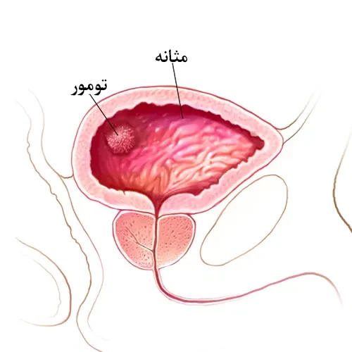 استفاده از ب ث ژ در سرطان مثانه