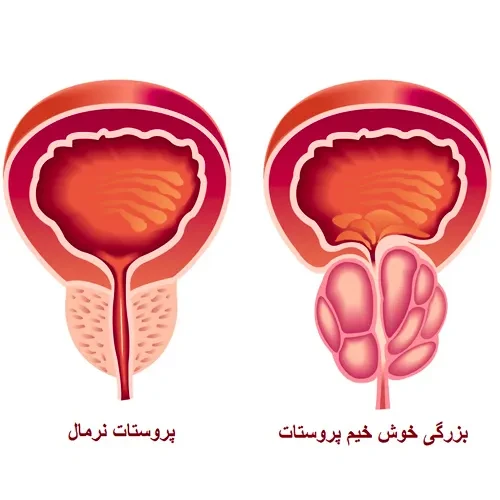 بزرگی خوش خیم پروستات از موارد احتیاطی مصرف داروی بلادونا پی بی