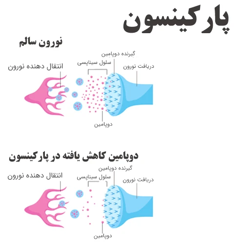 کنترل بیماری پارکینسون با مصرف داروی بنزتروپین