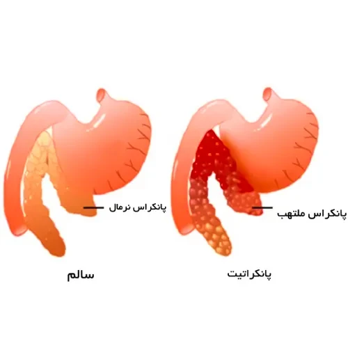 بیماری های پانکراس از موارد احتیاطی مصرف داروی کالاسپارگاز پگول