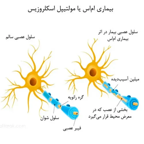 استفاده از داروی کانابیدیول در درمان ام اس