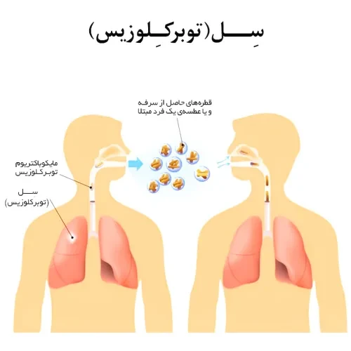 درمان سل با مصرف داروی کاپرئومایسین