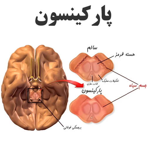 کنترل علائم ناشی از پارکینسون با داروی کاربی دوپا-لوودوپا