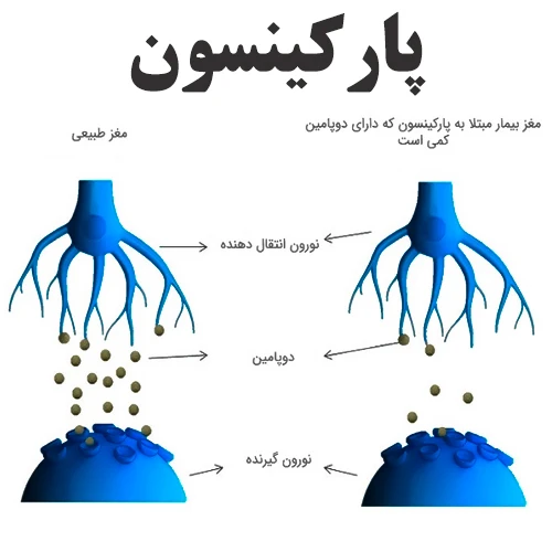 کنترل علائم ناشی از پارکینسون با داروی کاربی دوپا