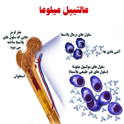 تاثیر داروی کیپرولیس (کارفیلزومیب) در سرطان مالتیپل میلوما