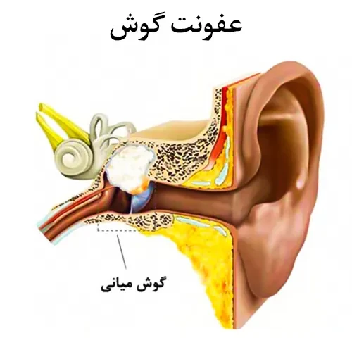 درمان عفونت گوش با مصرف داروی سفاکلور