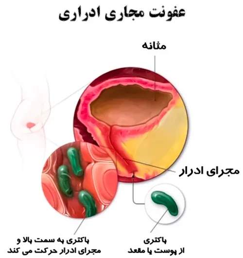 درمان عفونت مجاری ادراری با مصرف داروی سفیدروکول