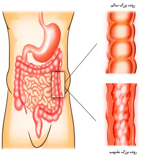 بیماری های معده و روده از موارد احتیاطی مصرف داروی سفیدروکول