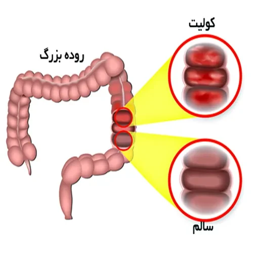 بیماری کولیت از موارد احتیاطی مصرف داروی سفوکسیتین