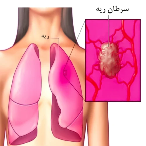 داروی سریتینیب (Ceritinib) درمان سرطان ریه